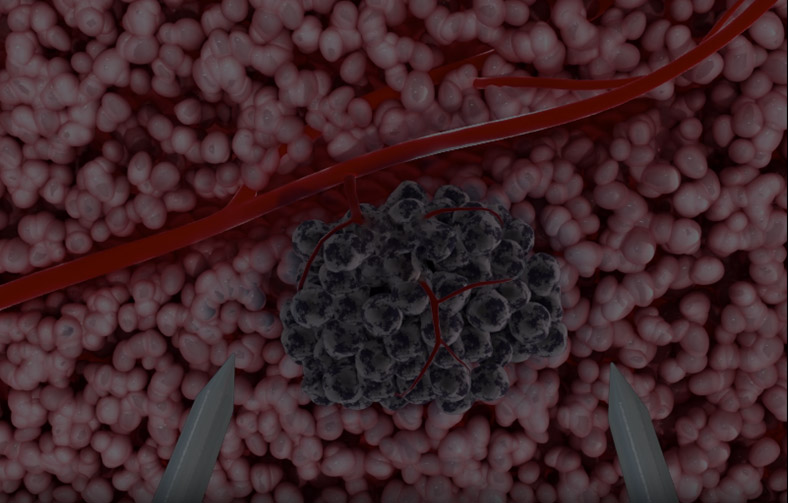 Broadband Steep-Pulse Tumor Ablation Therapy Device（Wknife）