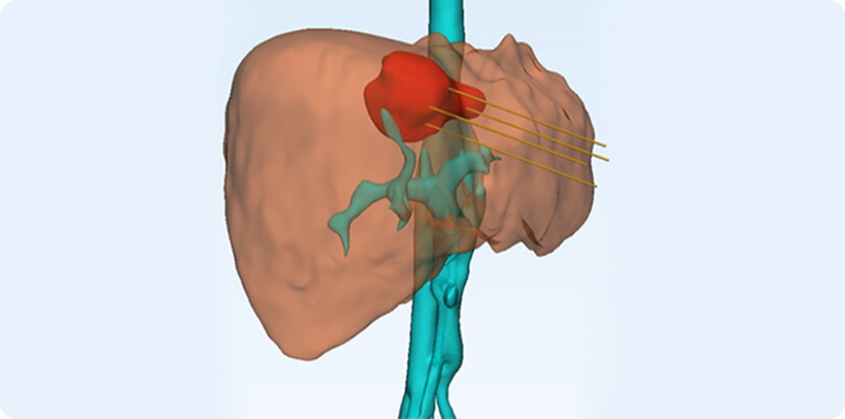 Precise Energy Delivery, Controllable Range