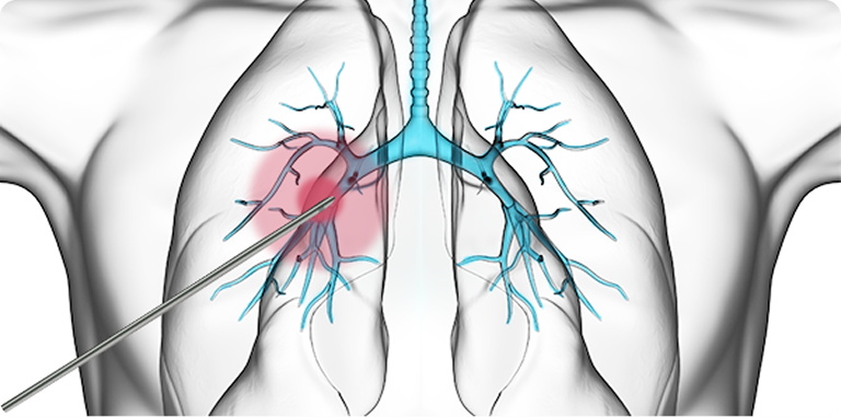 Minimally Invasive with Local Anesthesia, Simple Operation